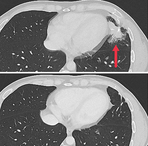 Cross-sectional CT images showing a metastatic tumor in the left lung of a patient (top image) and no tumor following treatment (bottom image)