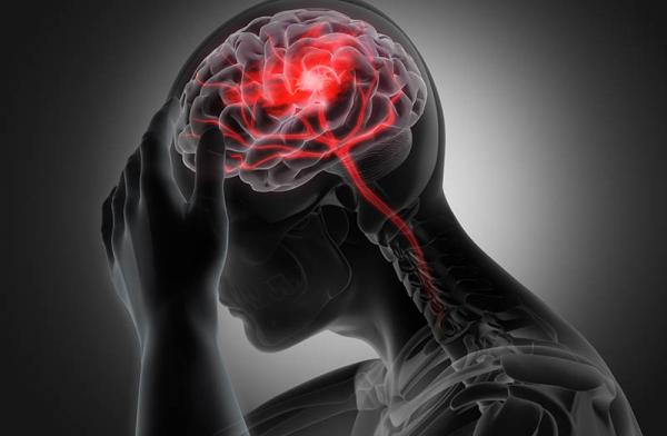 x-ray view of the brain as a person experiences a stroke