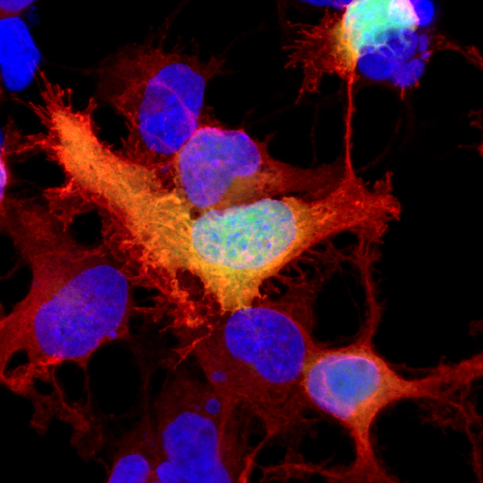 Glioma and Astrocytoma