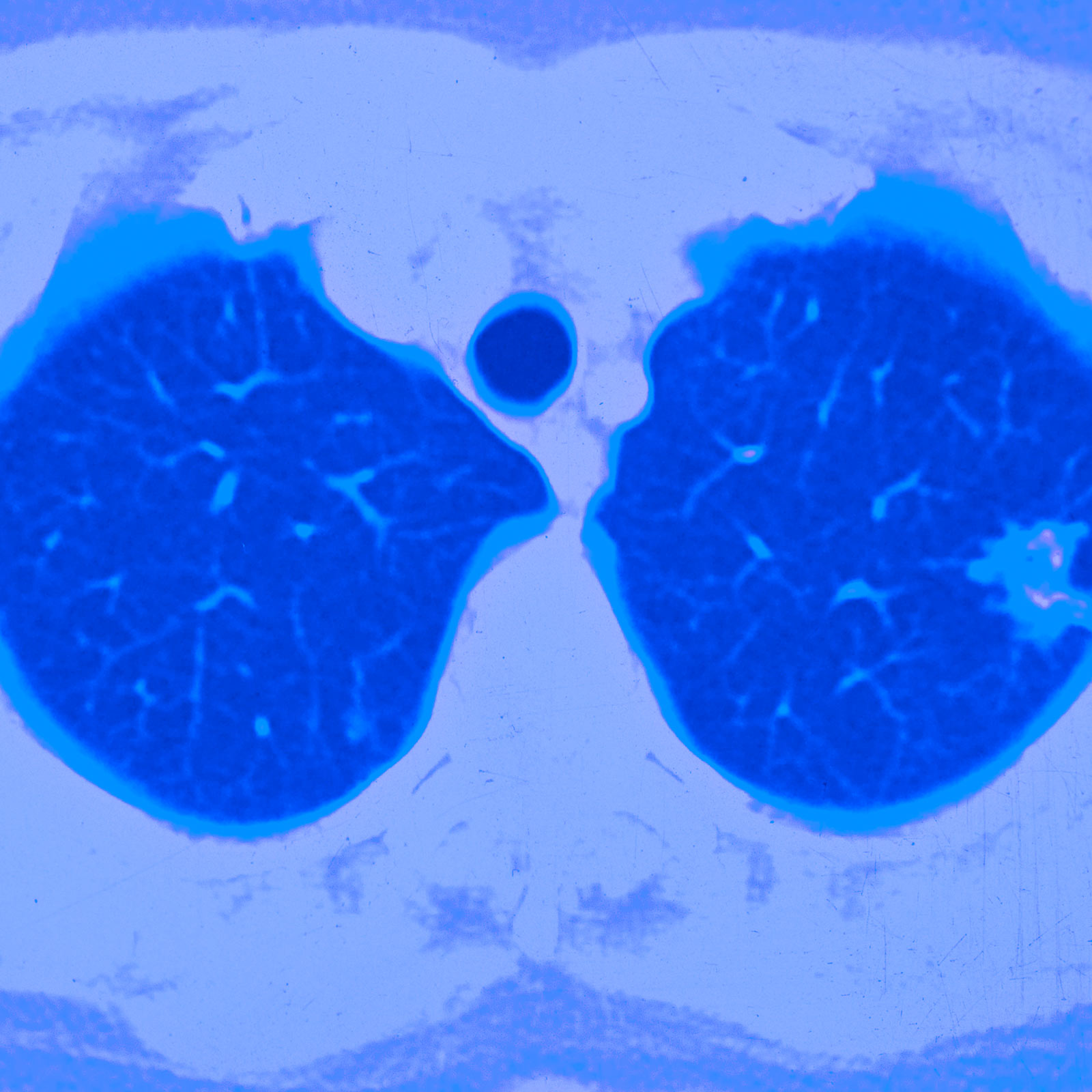 Non-Small Cell Lung Cancer Treatment