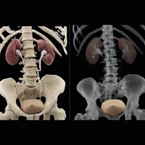 Radiograph of the Kidneys, Ureters, and Bladder