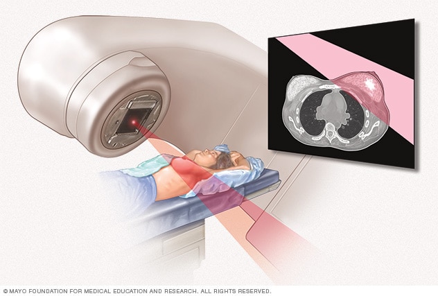 Radiation therapy for breast cancer