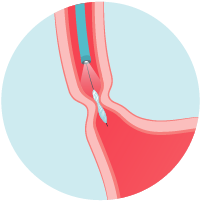 The doctor guides a balloon down to the narrowed section of the esophagus.