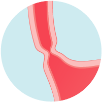 Patient experiences difficulty swallowing due to narrowed section of the esophagus.