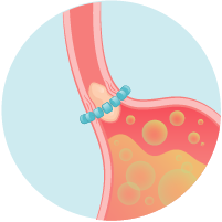 LINX system expands to allow for normal swolling.