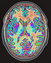 Brain structure changes linked to impairment after stroke