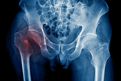 Fracture risk in older men