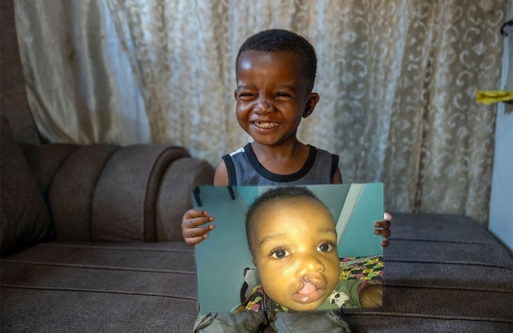 Joshua holding a picture of himself before cleft surgery