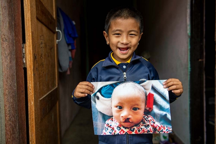 A boy from Nepal holding his before cleft surgery image