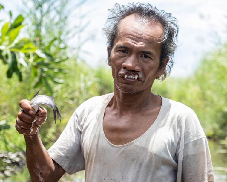 Alim fishing before cleft surgery