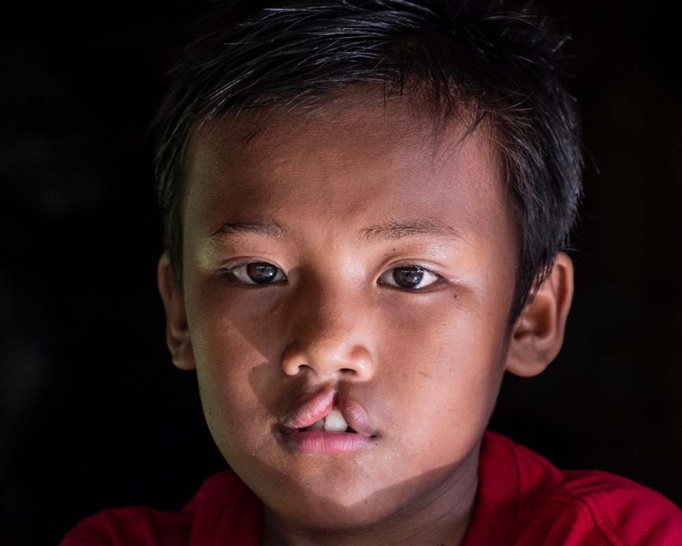 Rajib before cleft surgery