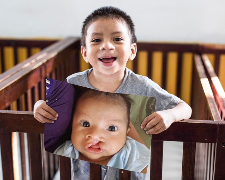 Auner holds a picture of himself before cleft surgery