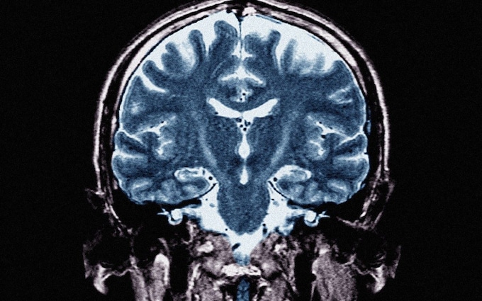 Motor neurone disease