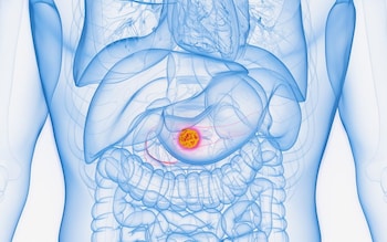 Pancreatic cancer