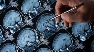 Diabetes drug may reverse Alzheimer’s symptoms - Fox News