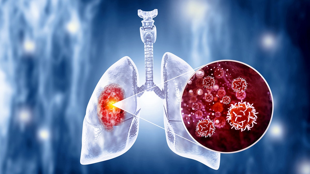 Concept photo showing lung cancer