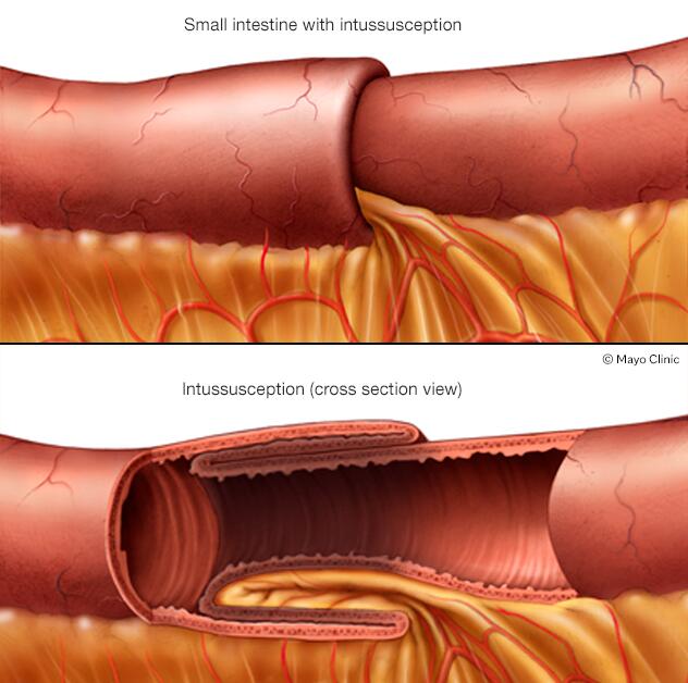 Invaginación intestinal