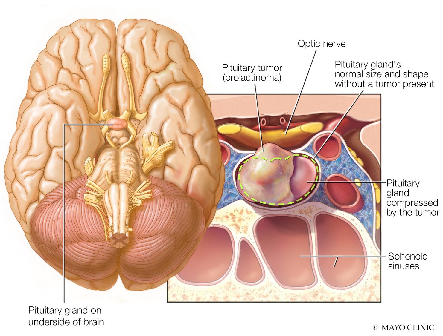 Prolactinoma en la glándula pituitaria