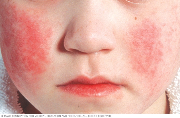 细小病毒感染的面部皮疹
