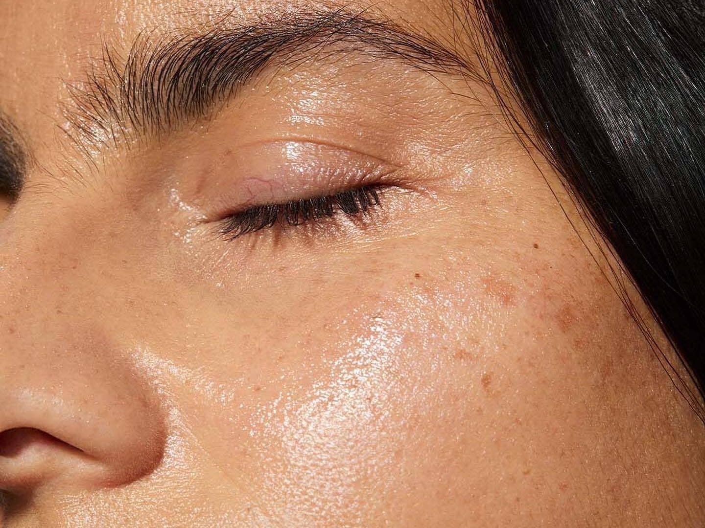 7 Things You Should Know About Preventing Summer Acne