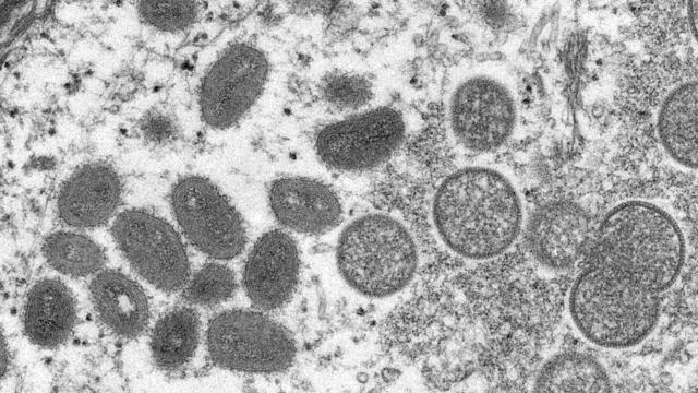 CDC microscopic image shows monkeypox virus particles 