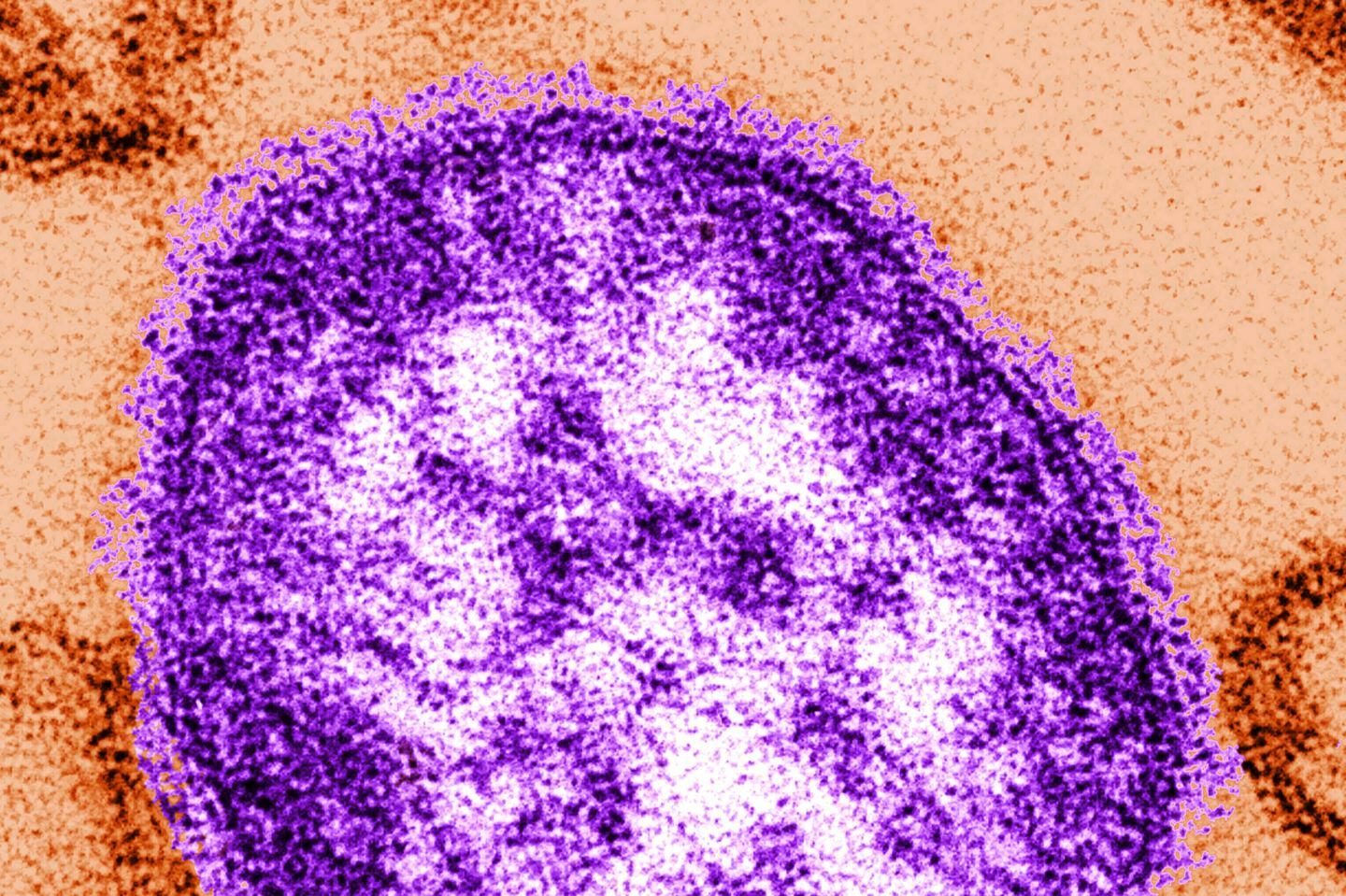 This undated image made available by the Centers for Disease Control and Prevention shows an electron microscope image of a measles virus particle.