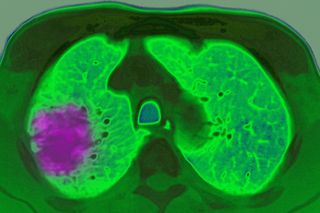 A cancer diagnosis of lung cancer, showing up in an axial plane chest MRI scan.