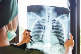 A doctor holding a lung X-ray.