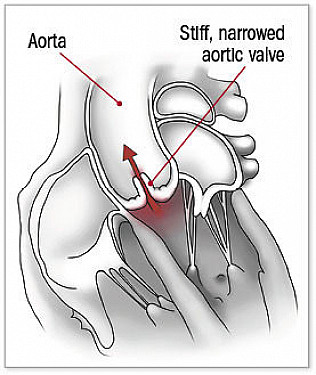 Aortic valve replacement options featured image