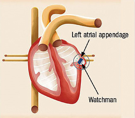 A device to prevent strokes in afib featured image