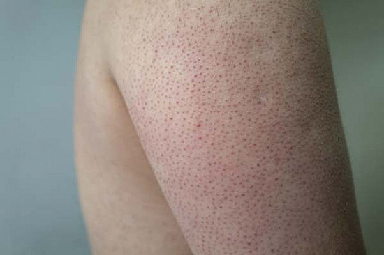 Keratosis pilaris: Treatment and self-care for this common skin condition featured image