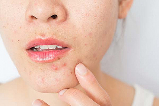 Perioral dermatitis: Symptoms, treatment, and prevention featured image