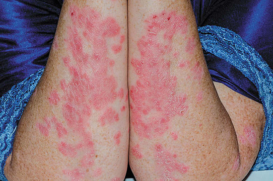 The wide-ranging effects of psoriasis featured image