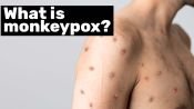 Epidemiologist Answers Common Monkeypox Questions