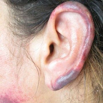 Cocaine rots your skin and turns your ears black