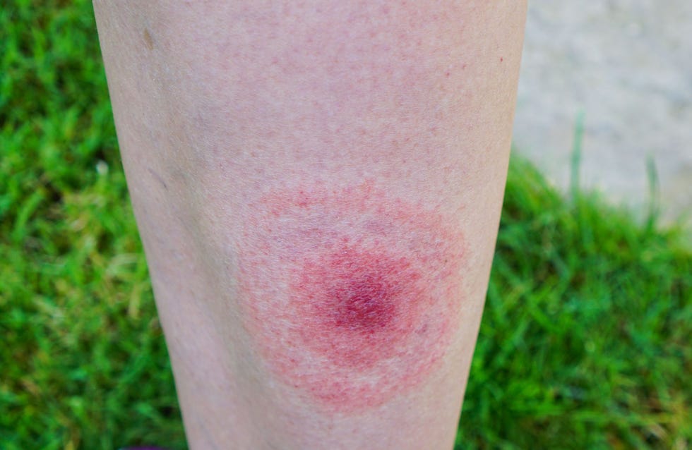 what do tick bites look like