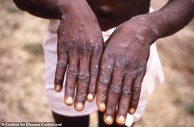 A fresh monkeypox (pictured) warning has been issued in Victoria as cases nearly double within 16 days in the state. Pictured is a case from Congo, Africa