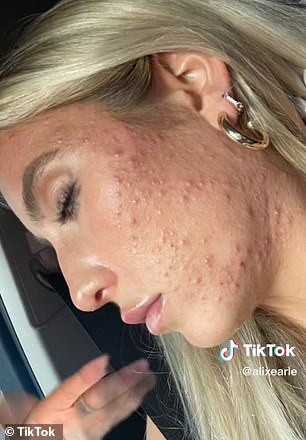 Alix has been open about her struggles with acne and has even shared photos showing her pre-Accutane