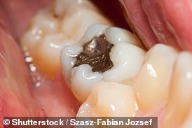 The European Parliament is set to ban dental amalgam - used in common silver fillings - amid fears over its toxicity