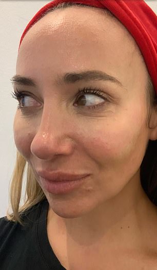 Dr Leonard pictured before polynucleotide treatment. The 40-year-old says she got the treatment improve the appearance of eczema and dry skin around her eyes