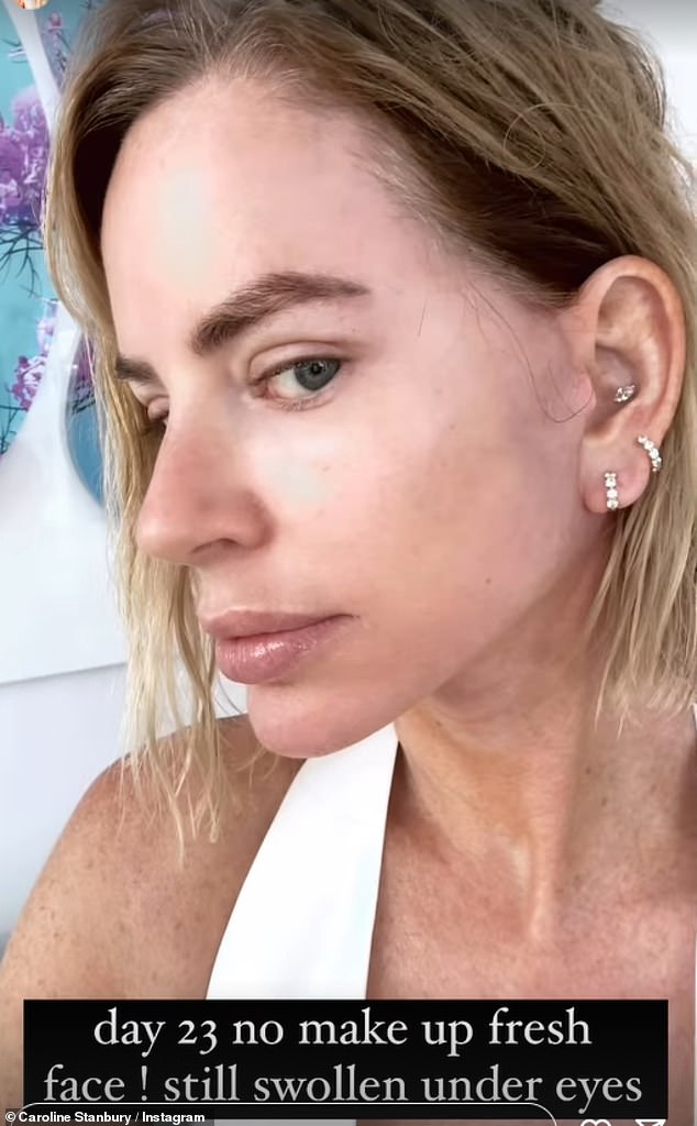 The Real Housewives of Dubai star, 48, who was previously in a relationship with Prince Andrew, told how she had her cheeks 'rebuilt' to appear more youthful