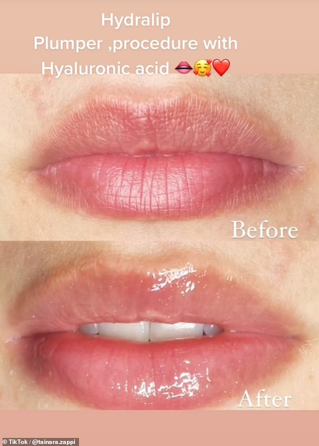 TikTok creator @tainara.zappi swears by hyaluronic acid for plumper lips, sharing before and after shots of her transformation