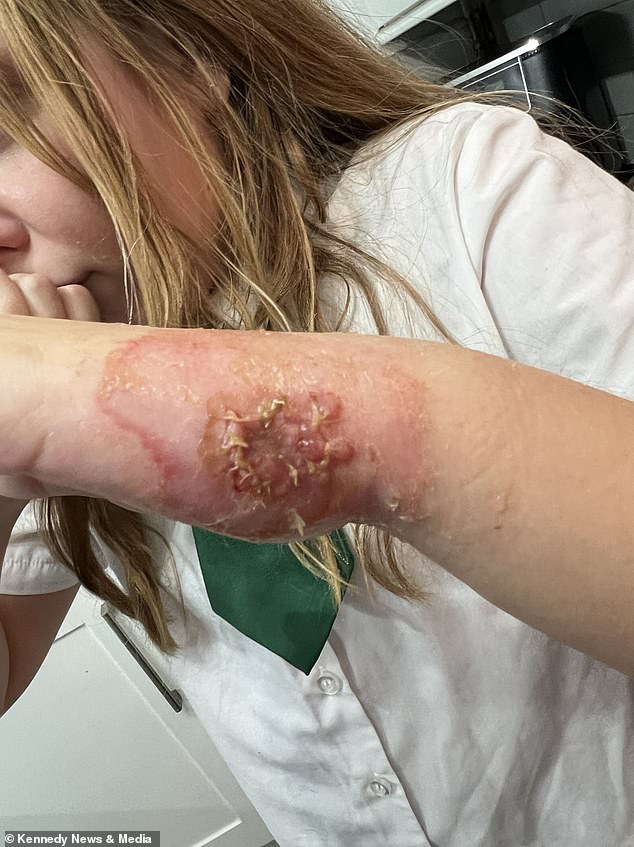 Chloe, from Kent, was left with severe third-degree burns after she bought the nail glue with her own money at the beginning of December