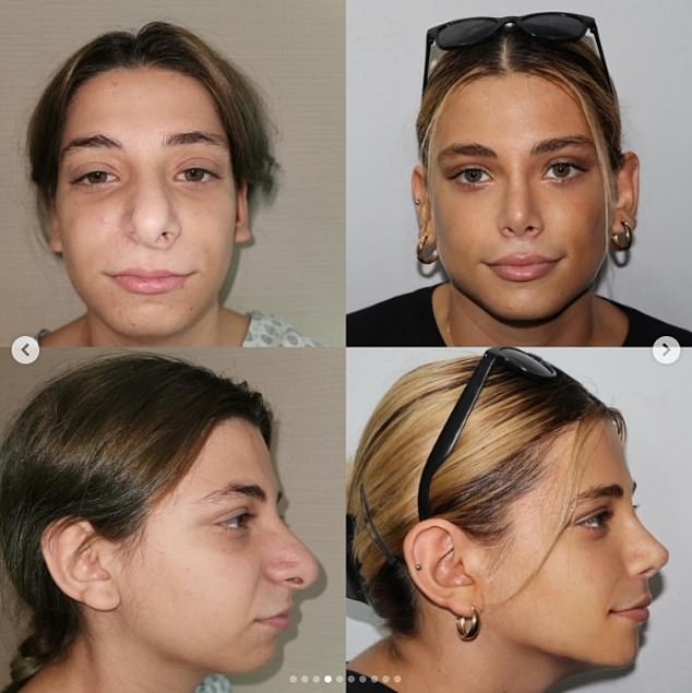 Nadya is pictured two years after her rhinoplasty, V shape jawline, cheek lift, under eye bag rejuvenation and temporal lifting procedures, according to Este Hospital