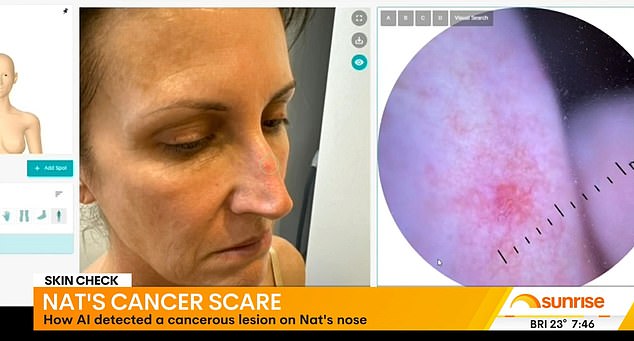 Natalie Barr shocked Sunrise viewers on Tuesday morning by revealing she had recently been diagnosed with skin cancer .