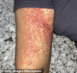 About one in four people who are infected suffer from symptoms of the virus, including a rash
