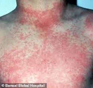 One of the symptoms of dengue fever is a rash as pictured above