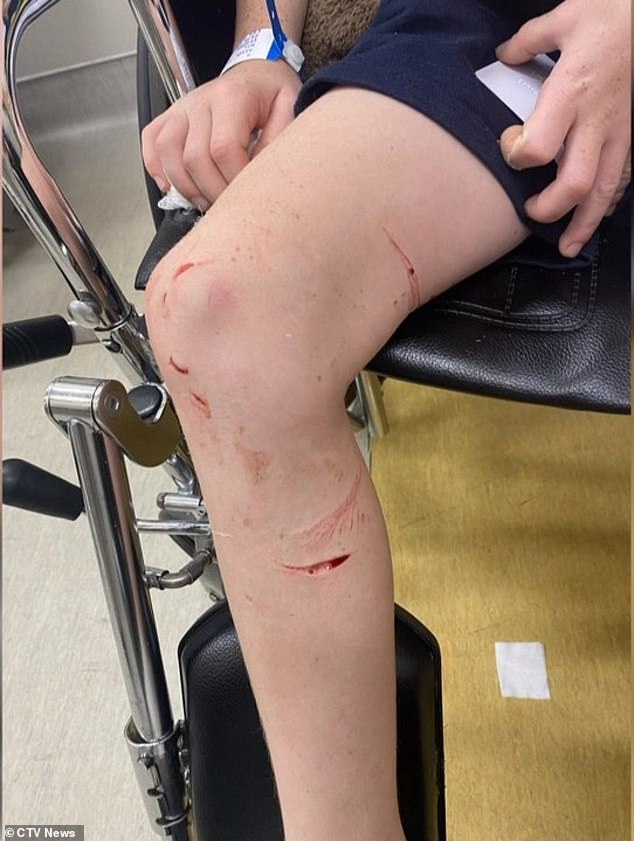 Max Mandl, 8, was left bleeding and screaming in pain after he being attacked by a fish while at a beach in Montreal, Canada