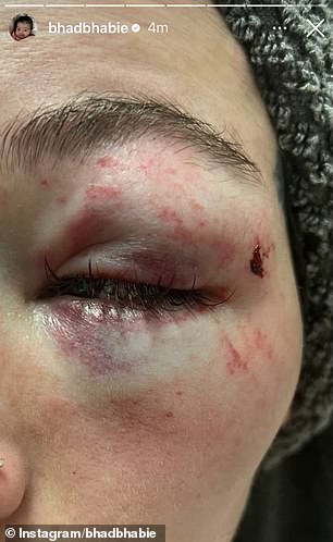 On Sunday, the rapper and OnlyFans star detailed the violence she claims he subjected her to and the shocking injuries she says she sustained (pictured)