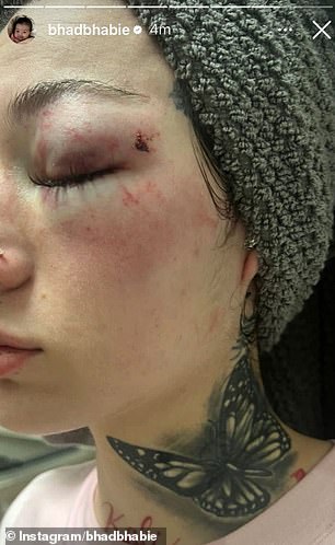 She had injuries to her cheek and eye